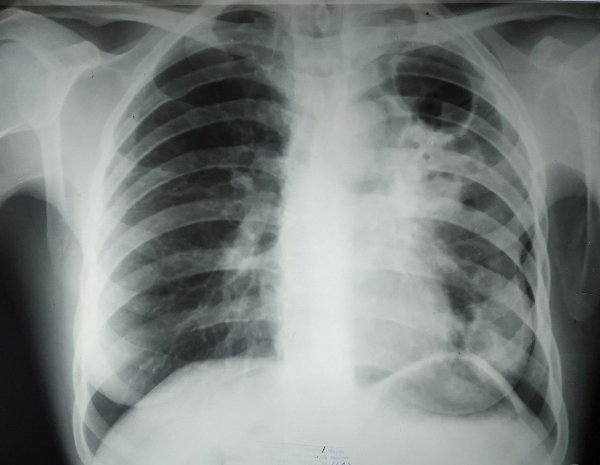 Стволовые клетки лёгких скрывают и защищают бактерии туберкулёза